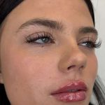 Lip Filler Before & After Patient #952