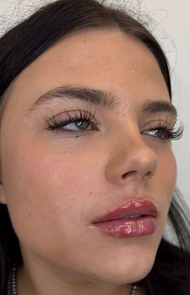 Lip Filler Before & After Patient #952