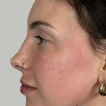 Full Facial Balancing Before & After Patient #914