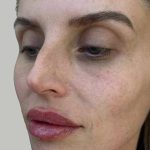 Lip Filler Before & After Patient #965