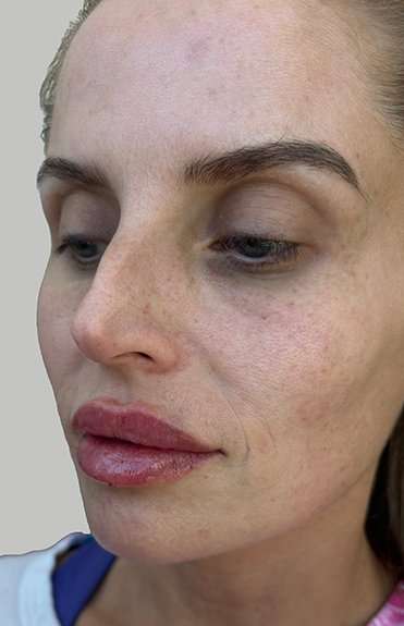 Lip Filler Before & After Patient #965