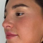 Lip Filler Before & After Patient #981