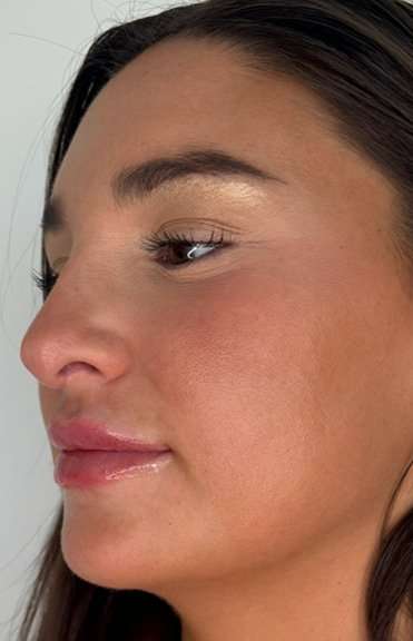 Lip Filler Before & After Patient #981