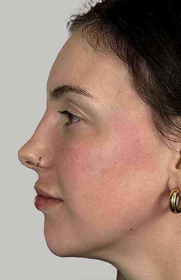 Full Facial Balancing Before & After Patient #914