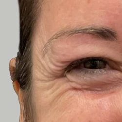 Botox/Dysport Before & After Patient #859