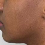Full Facial Balancing Before & After Patient #862