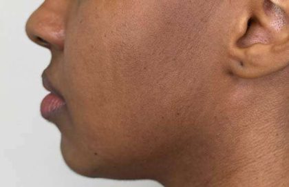 Full Facial Balancing Before & After Patient #862