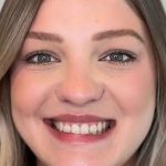 Full Facial Balancing Before & After Patient #865