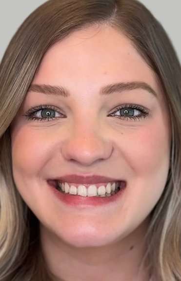 Full Facial Balancing Before & After Patient #865