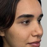 Full Facial Balancing Before & After Patient #868