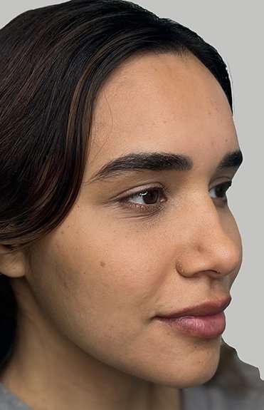 Full Facial Balancing Before & After Patient #868