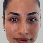 Full Facial Balancing Before & After Patient #871