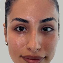 Full Facial Balancing Before & After Patient #871