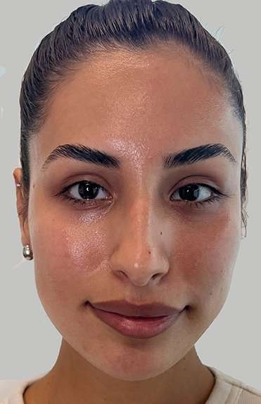 Full Facial Balancing Before & After Patient #871