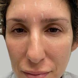 Full Facial Balancing Before & After Patient #874