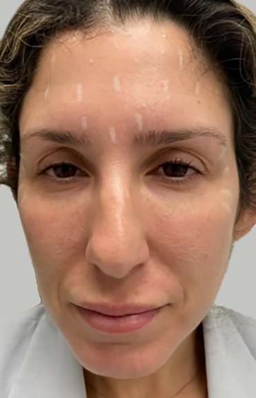 Full Facial Balancing Before & After Patient #874