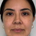 Full Facial Balancing Before & After Patient #877