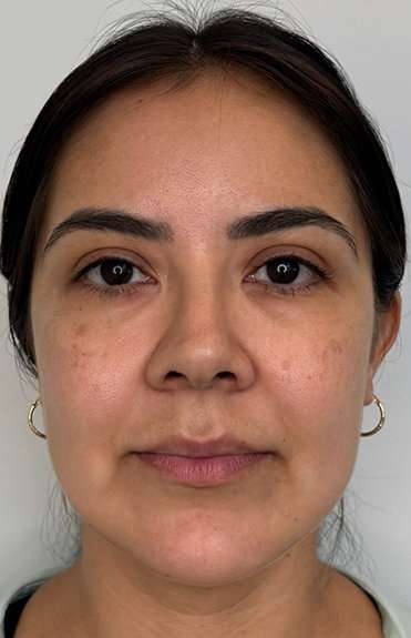 Full Facial Balancing Before & After Patient #877