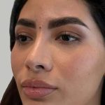 Full Facial Balancing Before & After Patient #880