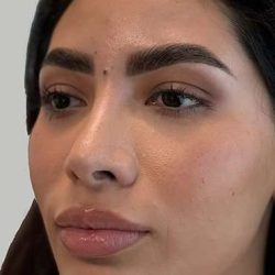 Full Facial Balancing Before & After Patient #880