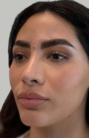 Full Facial Balancing Before & After Patient #880