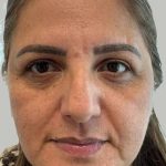 Full Facial Balancing Before & After Patient #883