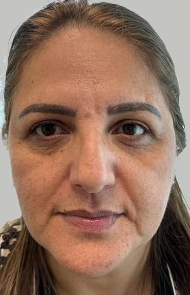 Full Facial Balancing Before & After Patient #883