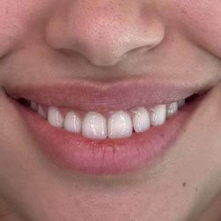 Botox/Dysport Before & After Patient #828