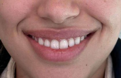 Botox/Dysport Before & After Patient #828