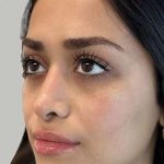 Full Facial Balancing Before & After Patient #886