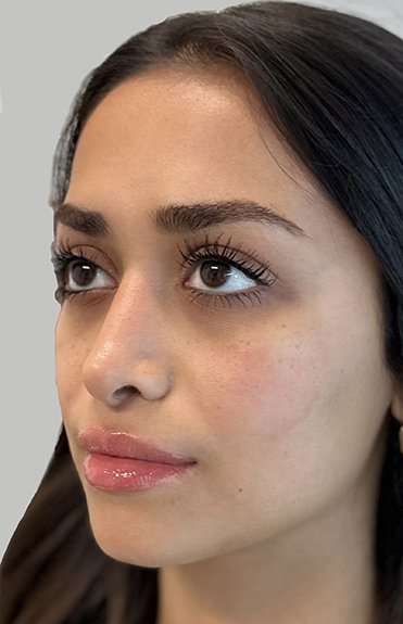 Full Facial Balancing Before & After Patient #886