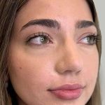 Full Facial Balancing Before & After Patient #889