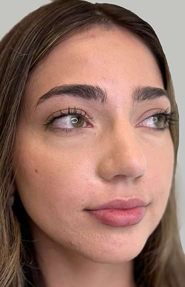 Full Facial Balancing Before & After Patient #889
