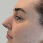 Full Facial Balancing Before & After Patient #892