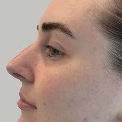 Full Facial Balancing Before & After Patient #892