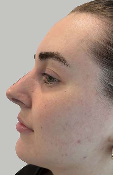 Full Facial Balancing Before & After Patient #892