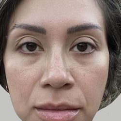 Full Facial Balancing Before & After Patient #895
