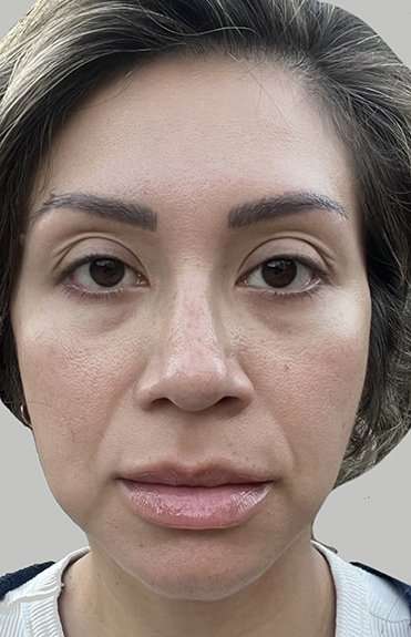 Full Facial Balancing Before & After Patient #895