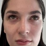 Full Facial Balancing Before & After Patient #898