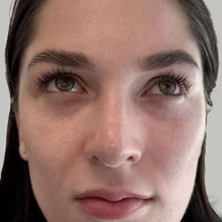 Full Facial Balancing Before & After Patient #898