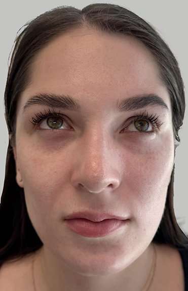 Full Facial Balancing Before & After Patient #898