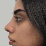 Full Facial Balancing Before & After Patient #901
