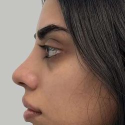 Full Facial Balancing Before & After Patient #901