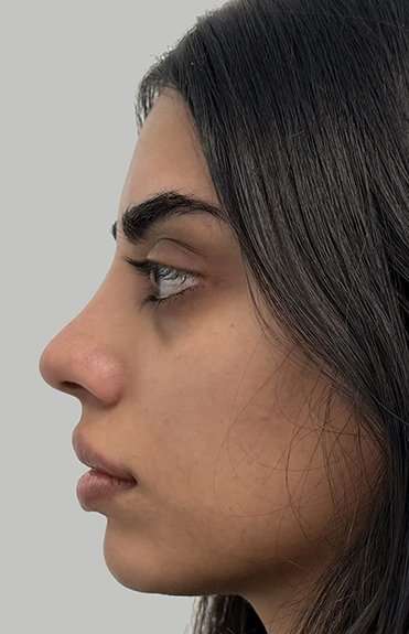 Full Facial Balancing Before & After Patient #901