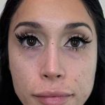 Full Facial Balancing Before & After Patient #904