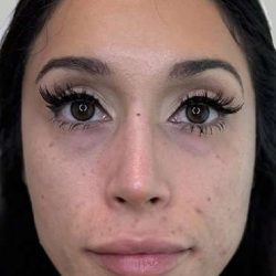 Full Facial Balancing Before & After Patient #904