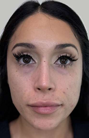 Full Facial Balancing Before & After Patient #904