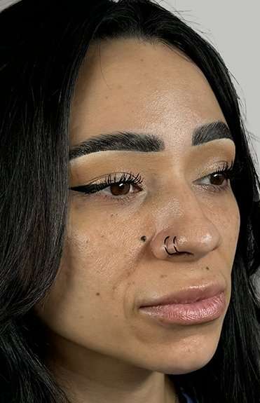 Full Facial Balancing Before & After Patient #907