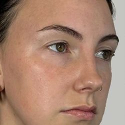 Full Facial Balancing Before & After Patient #914