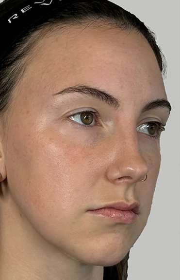 Full Facial Balancing Before & After Patient #914